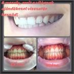 Best Nails - Fogfehérítés