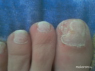 problémás lábköröm