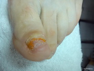 kicsit még jódos de gyógyul