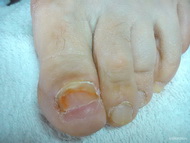 kicsit még jódos de gyógyul