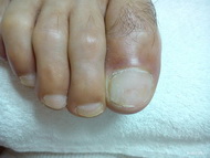 körömprotézis utána