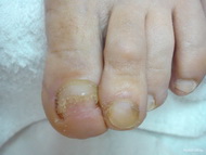 sérült körömrész eltávolítása