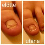 köröm korrekció