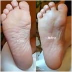 pedikűr előtte utána