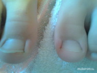 benőtt köröm kisfiúnak