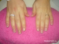 sk erősítése zselével