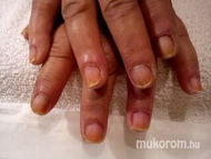 megsárgult körmök piros lakktól