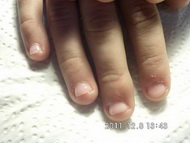 rágott körömre zselé