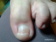 Kezelés után gombaölő zselével építve