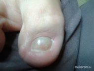 Kezelés után gombaölő zselével fedve