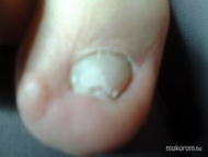 Gombás köröm kezelés előtt