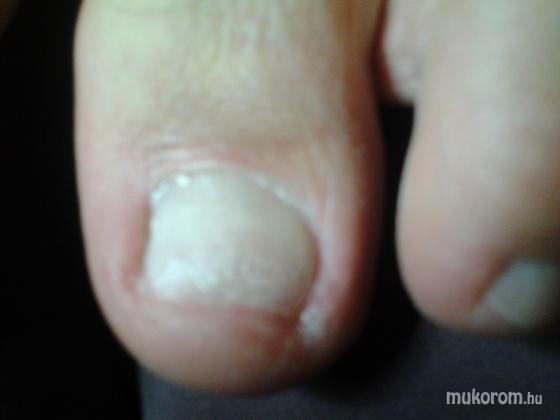 Nail Beauty körömszalon "crystal nails referencia szalon" - Gombás köröm kezelés előtt - 2012-03-12 20:06